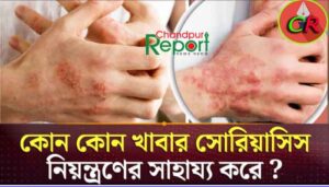 সোরিয়াসিস কত প্রকার ও কি কি? সোরিয়াসিস থেকে মুক্ত হওয়ার উপায় কি?