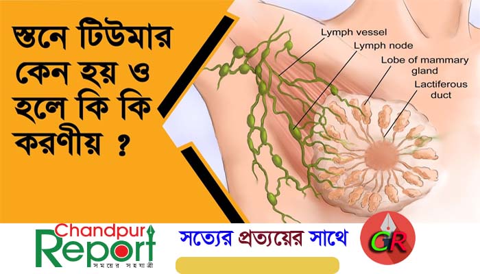 টিউমার কি? টিউমার এর কারণ ও প্রতিকার জেনে নিন