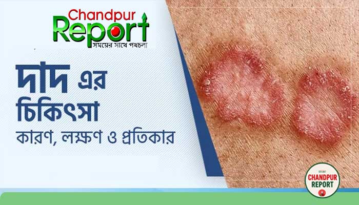 দাউদ থেকে পরিত্রাণ পাবার সাতটি ভেষজ উপায়